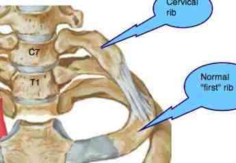 Cervical Rib Syndrome; Cervical-Rib-Cervical-Band Syndrome; Naffziger