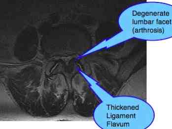 facet arthropathy lumbar mri pain spine leg lower syndrome spinal muscle piriformis subluxation vertebral nerve stenosis sciatic chiropractic help complex