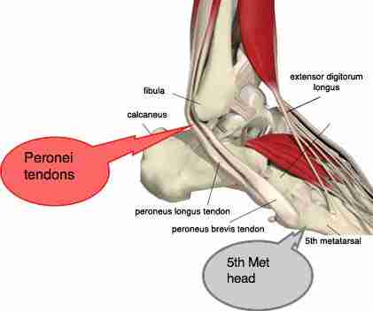Sprained ankle affects everyone; untreated you may develop chronic foot