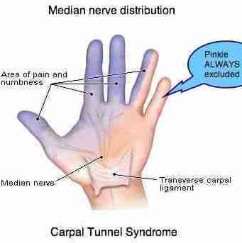 double crush syndrome