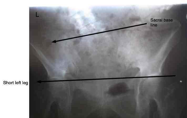 Causes Of Scoliosis