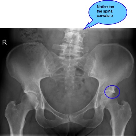 impingement pincer acetabular pain hip syndrome femoro groin chiropractic front leg thigh numbness shooting help chiropractor arthritis spur ray slight