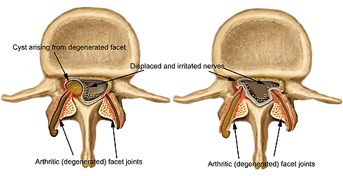 lumbar facet syndrome,