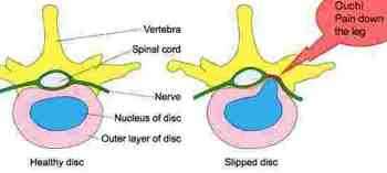 Herniated disc foot drop is caused by a trapped sciatic nerve.