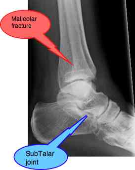 Ankle fracture is in the first instance a job for a surgeon.