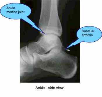 Ankle joint pain casefile follows a horrific staircase injury.