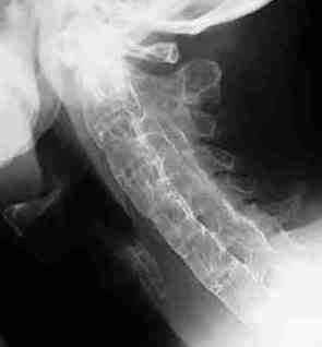 of list benefits exercise is symptom chiropractic Ankylosing about spondylitis