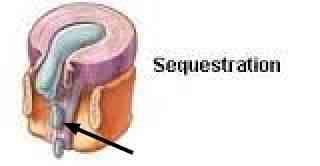 Sequestrated fragments of the disc in the lumbar spine.