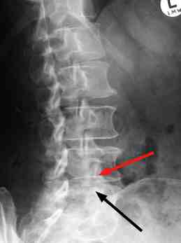 Cervical spine arthritis x ray - natstat