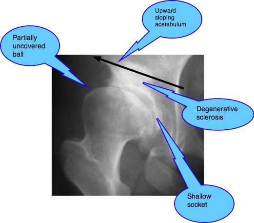 Kellgren Lawrence grading scale gives a x-ray rating of hip arthritis.