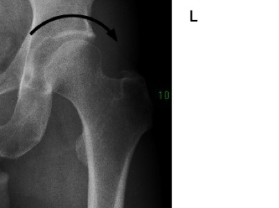 Hip Dysplasia Improperly Managed Leads Unerringly To Early Arthritis.