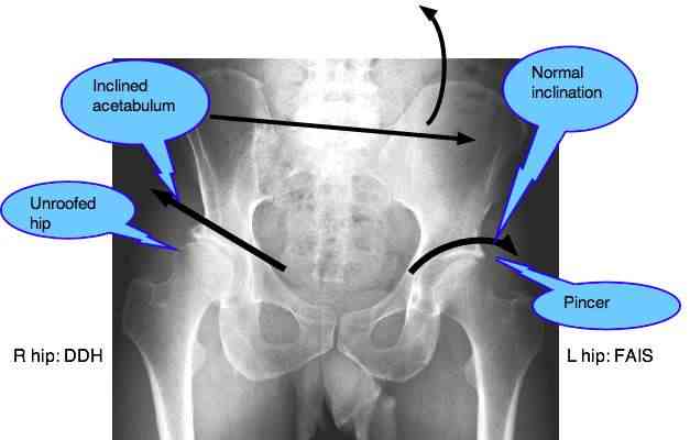 Kellgren Lawrence grading scale gives a x-ray rating of hip arthritis.