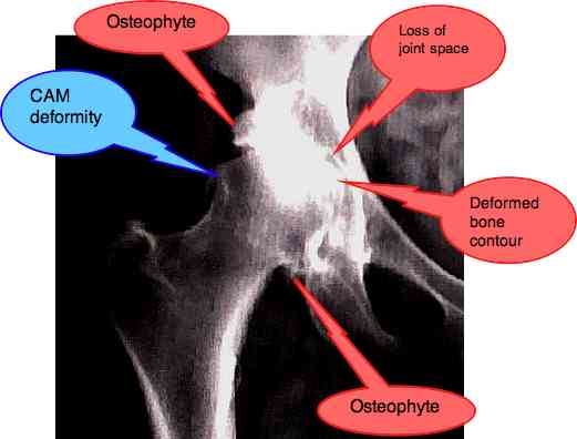 Kellgren Lawrence grading scale gives a x-ray rating of hip arthritis.