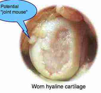 Bakers cyst knee can cause very sharp pain behind the leg.