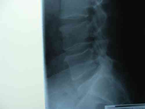 Lateral lumbar spine x-ray before an operation.