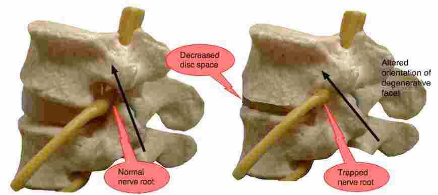 lumbar-facet-arthropathy-causes-lower-back-and-leg-pain-on-extension