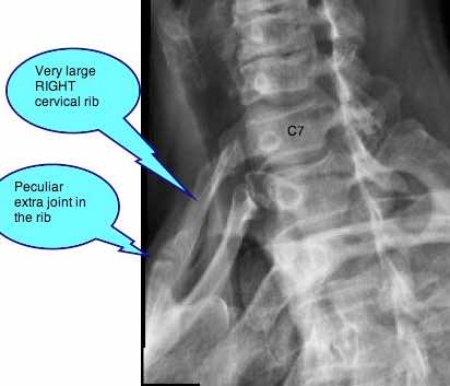 Cervical rib case file shows they are usually of little significance.