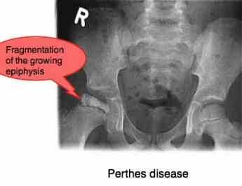 Never ignore upper leg pain in children, it could be Perthes disease