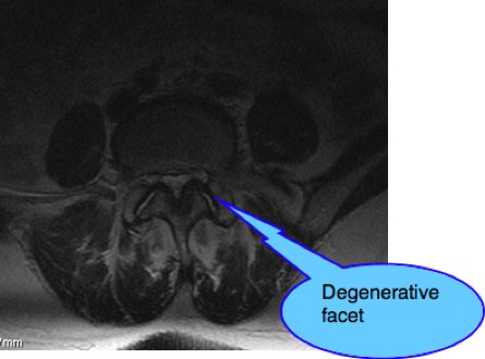 Spondylolysthesis case file explains the pain behind this ...