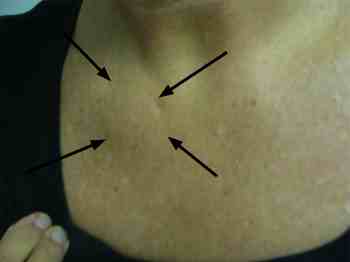 Tietzes syndrome and the sternoclavicular joint as a lump on the chest