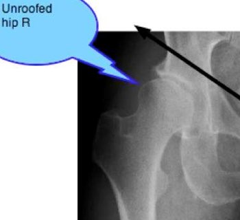 EDS, Hip Dysplasia, Hypermobility, Cam Impingement, joint subluxation