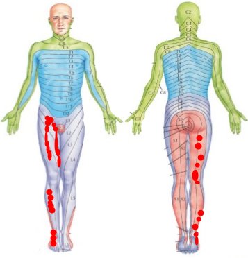 Femoral nerve injury from a PICC line