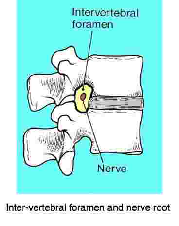 A sketch showing how the intervertebral foramen and the nerve root may cause leg pain.