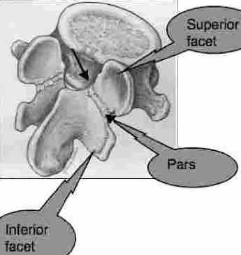 A pars defect between the facets.