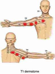 pins and needles in arm