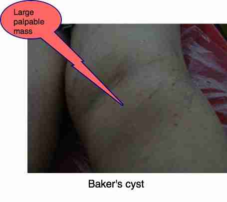 Bakers cyst knee can cause very sharp pain behind the leg.