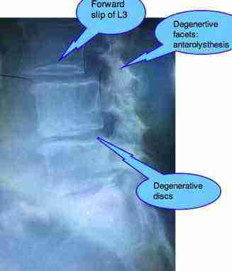 Degenerative lumbar disc disease case file runs down the anterior leg.