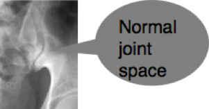 Ankylosing spondylitis symptom is about chiropractic management of AS.