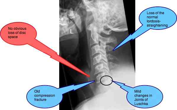 Slipped disc in neck is one of the most painful conditions 