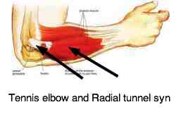 Tennis elbow is not just for sports players; anybody can get it.