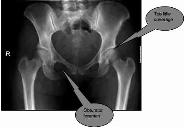 Femoro acetabular impingement syndrome causes severe stiffness in young ...